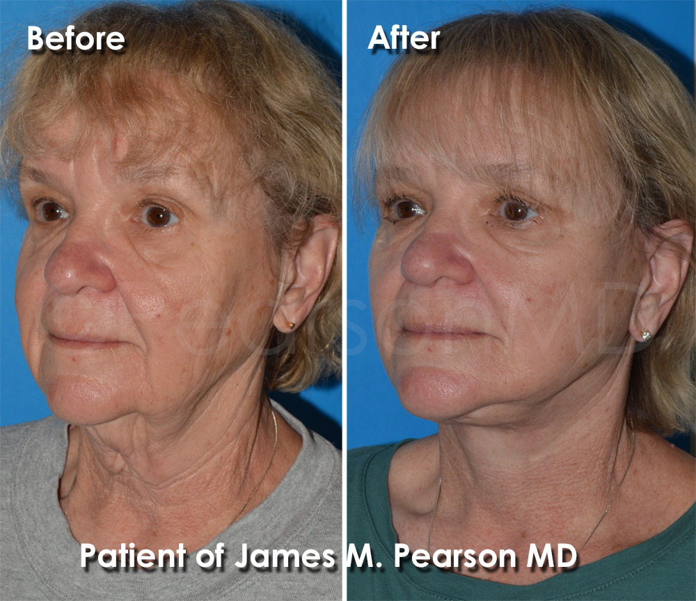 Dr. Pearson Facelift