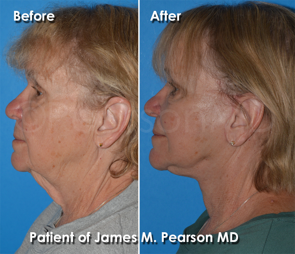 Dr. Pearson Facelift Surgery