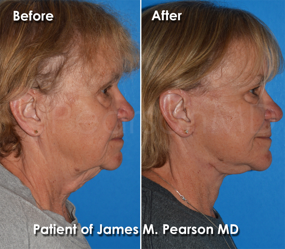 Pearson Plastic Surgery