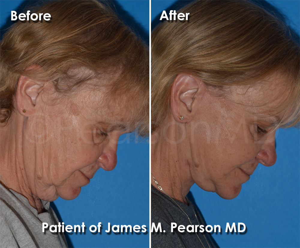 Pearson Plastic Surgery