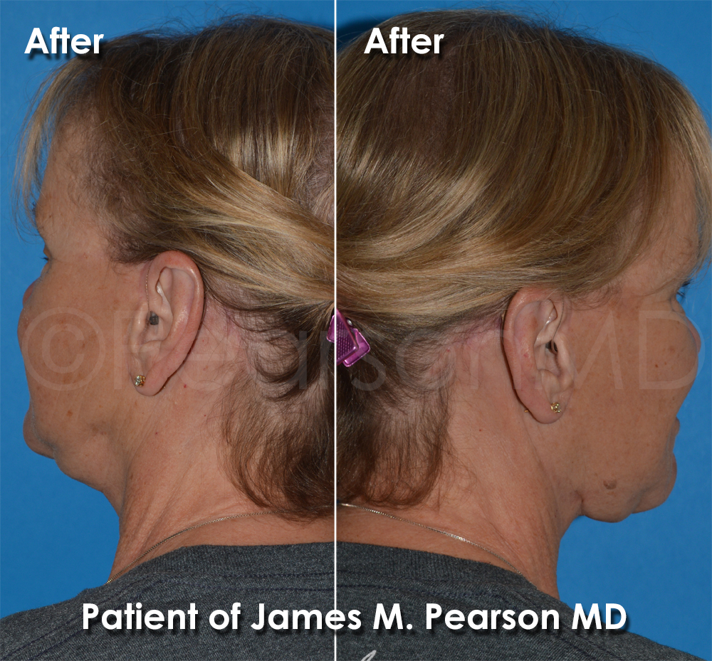 Pearson Plastic Surgery