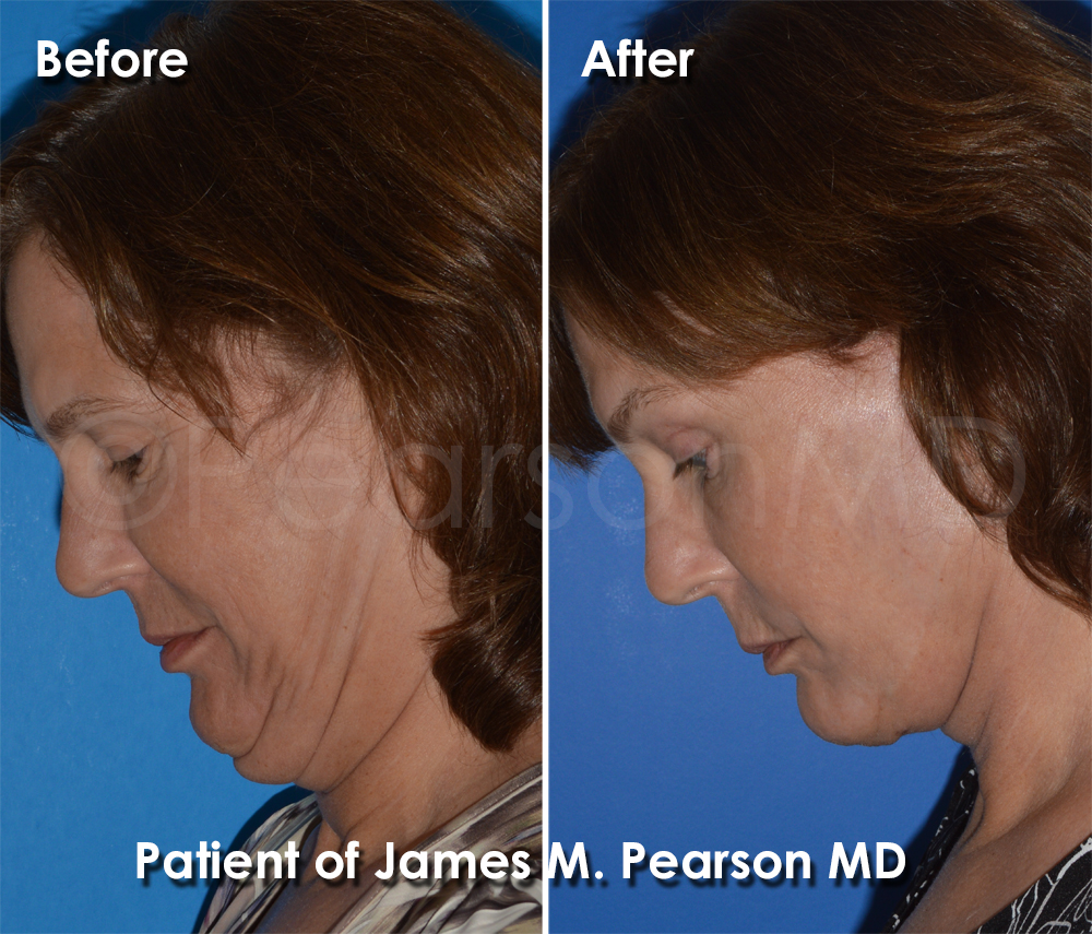 Dr. Pearson Facelift Surgery