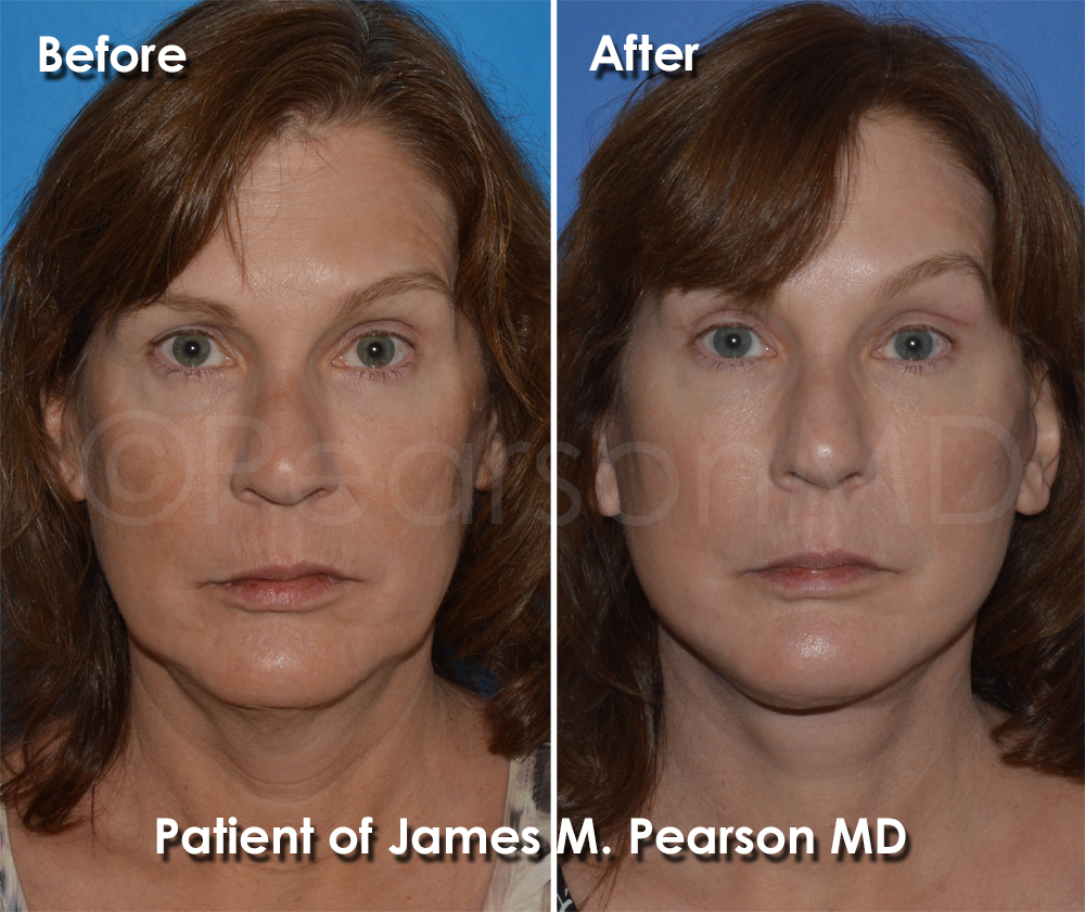 Dr. Pearson Facelift Surgery