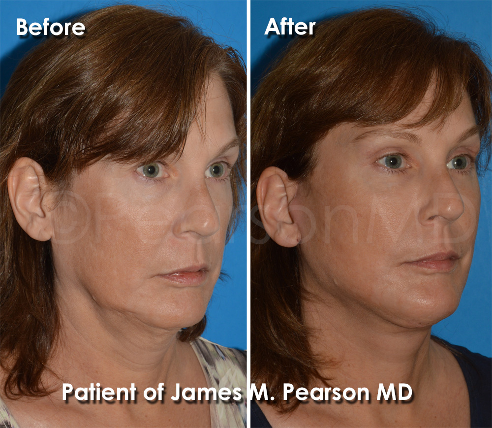 Dr. Pearson Facelift Surgery