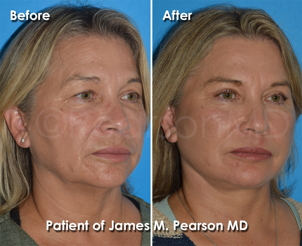 Dr. Pearson Facelift Surgery