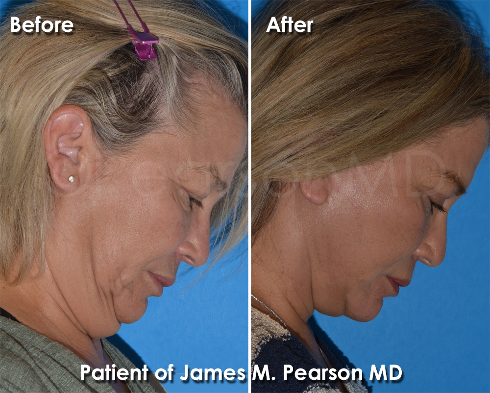Dr. Pearson Facelift Surgery