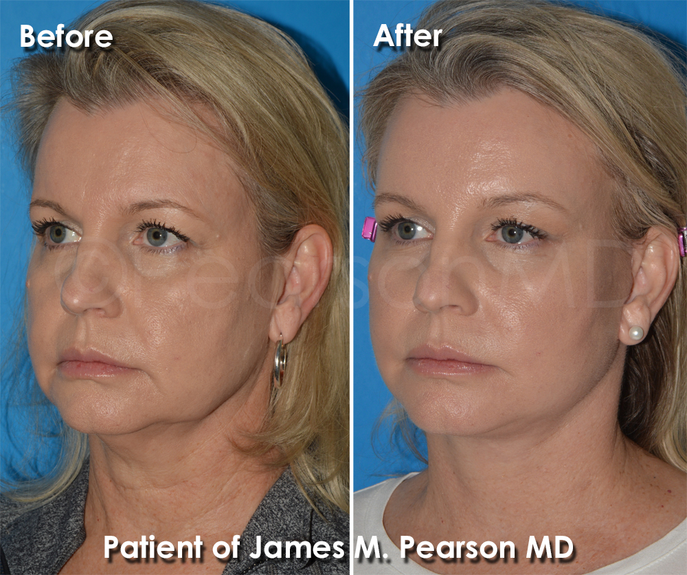 Dr. Pearson Facelift