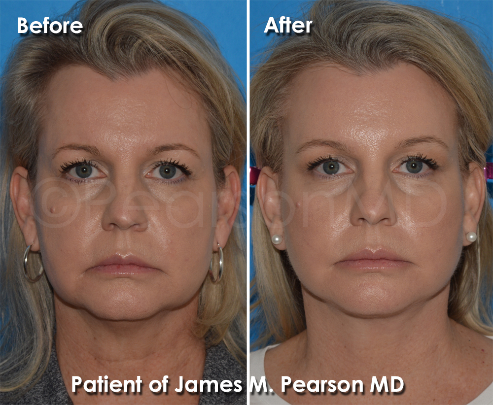 Pearson Plastic Surgery