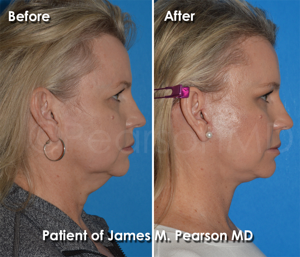 Dr. Pearson Facelift Surgery