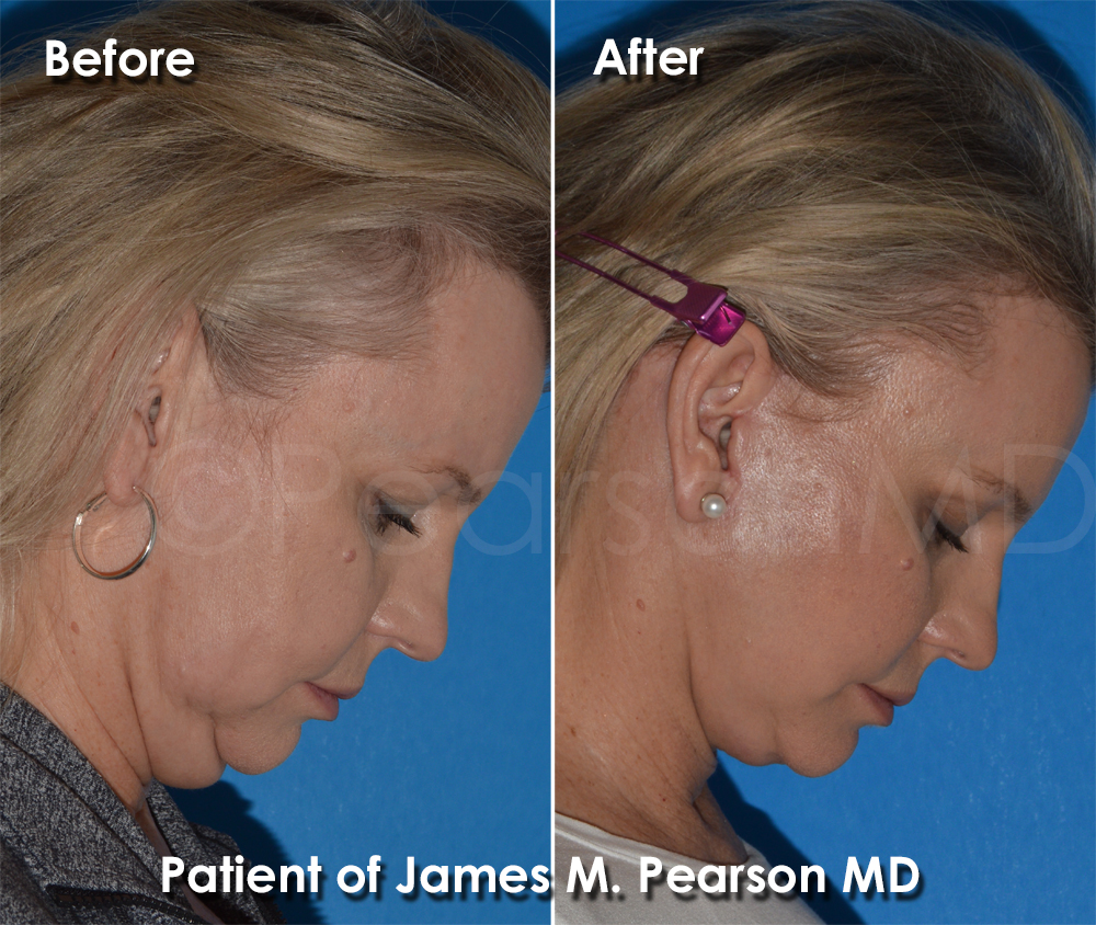 Dr. Pearson Facelift Surgery