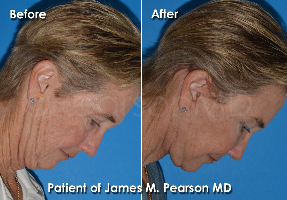 Dr. Pearson Facelift Surgery