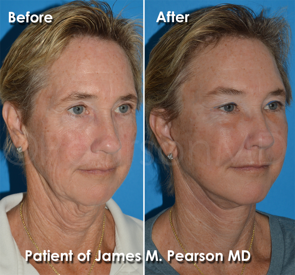 Dr. Pearson Facelift Surgery