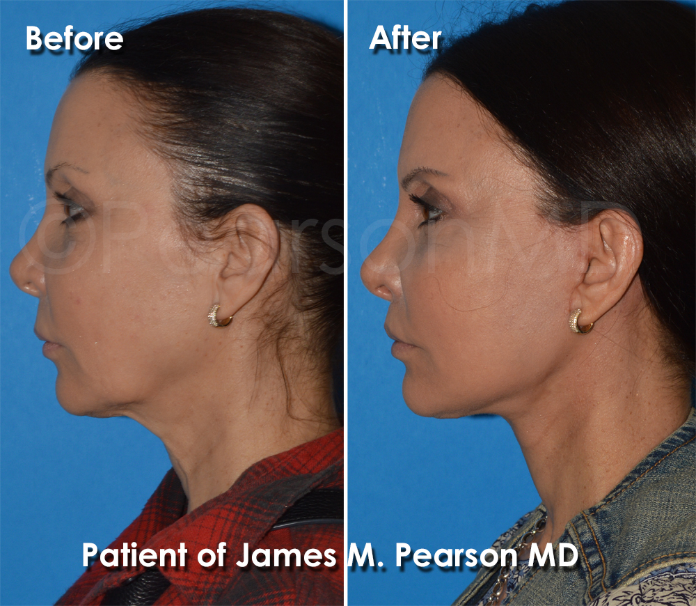 Dr. Pearson Facelift