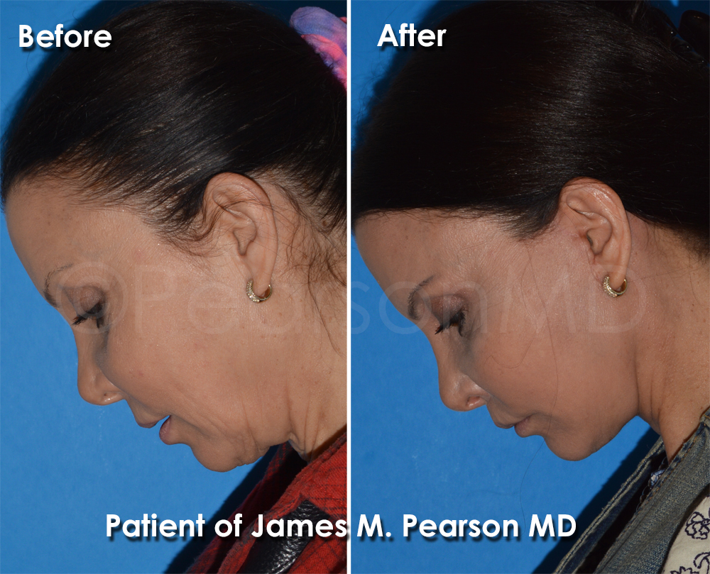Dr. Pearson Facelift Surgery