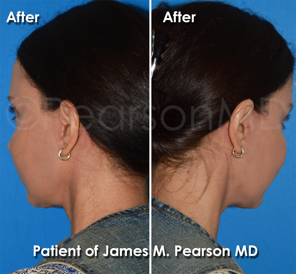 Dr. Pearson Facelift Surgery