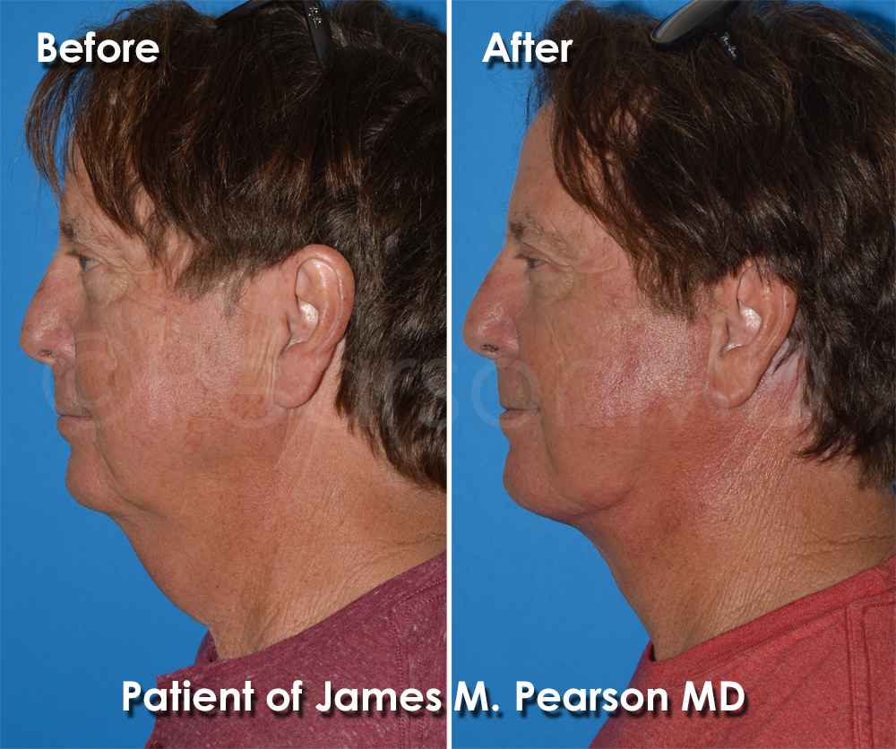 Dr. Pearson Facelift