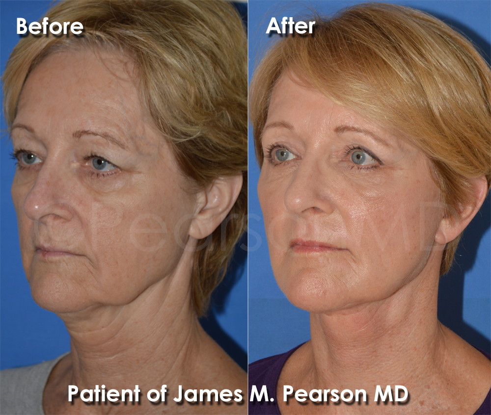 Pearson Neck Lift Photo