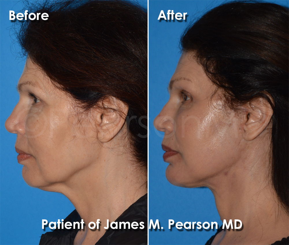 Dr. Pearson Facelift