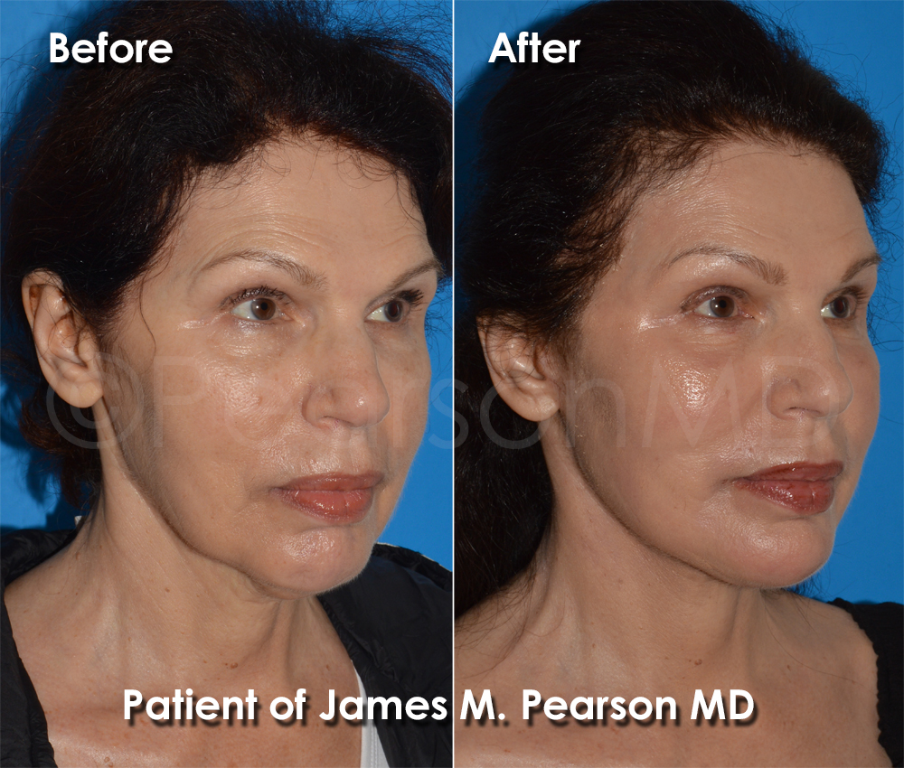 Pearson Plastic Surgery