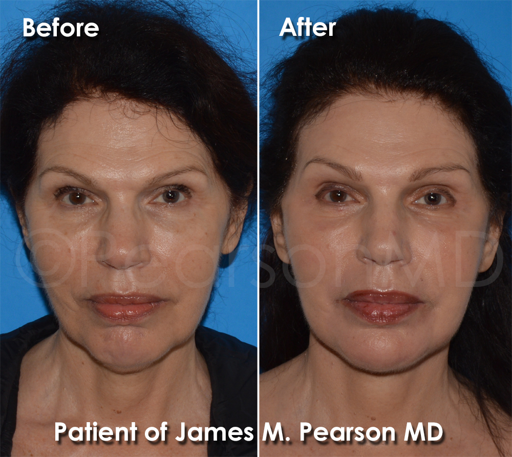 Dr. Pearson Facelift Surgery