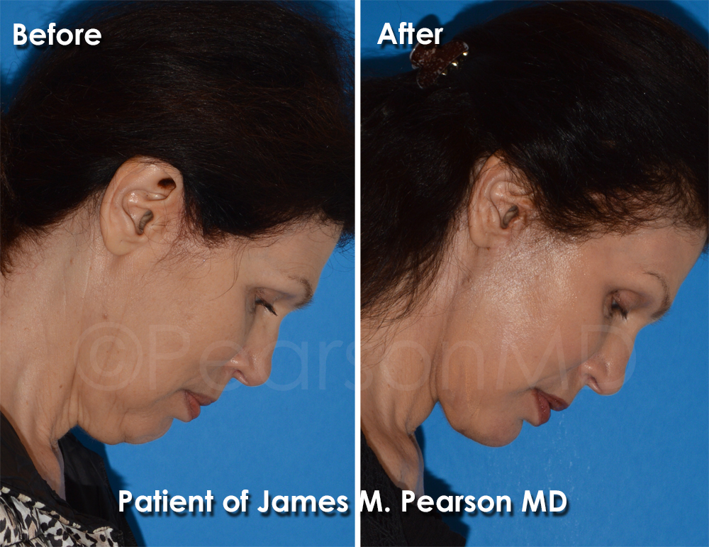 Dr. Pearson Facelift Surgery
