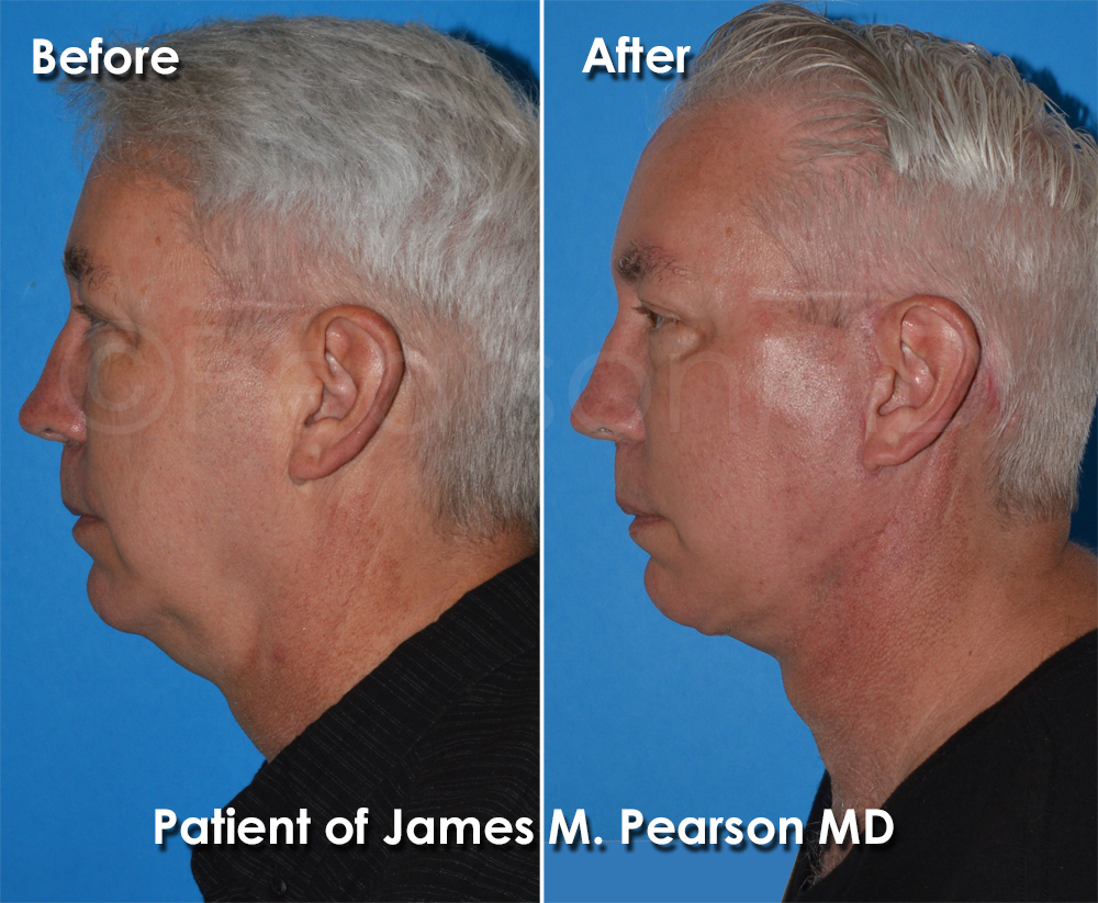 Dr. Pearson Facelift