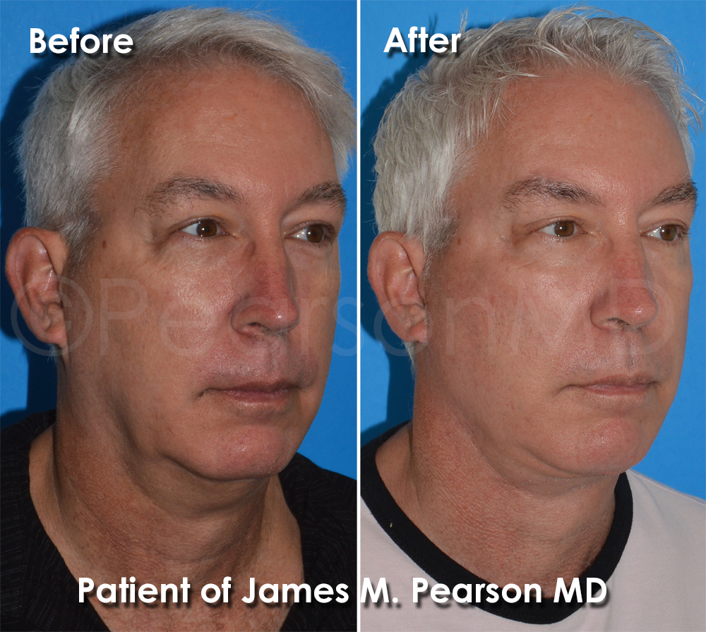 Pearson Plastic Surgery