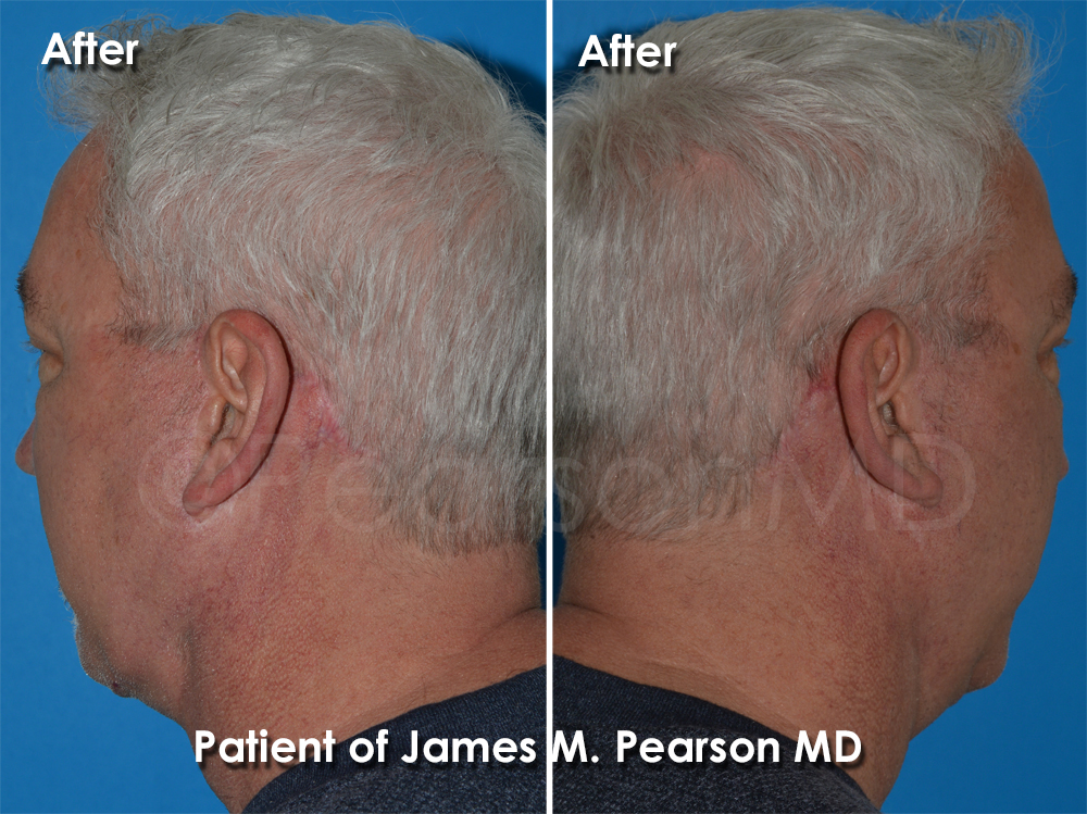 Dr. Pearson Facelift Surgery