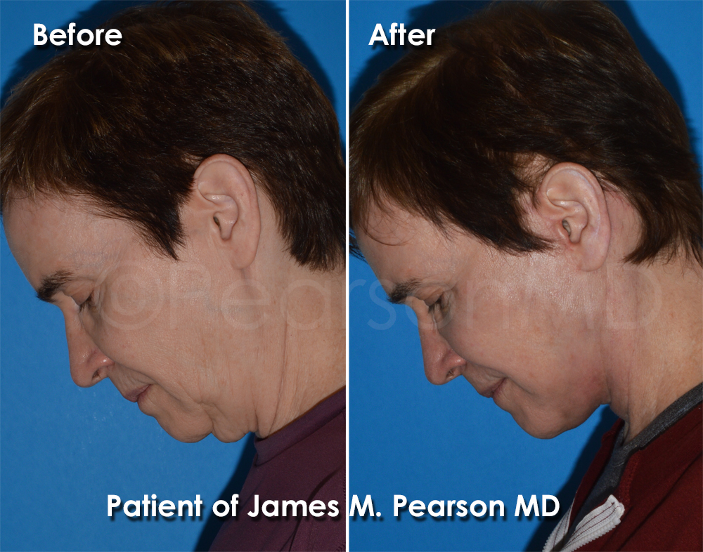 Dr. Pearson Facelift Surgery
