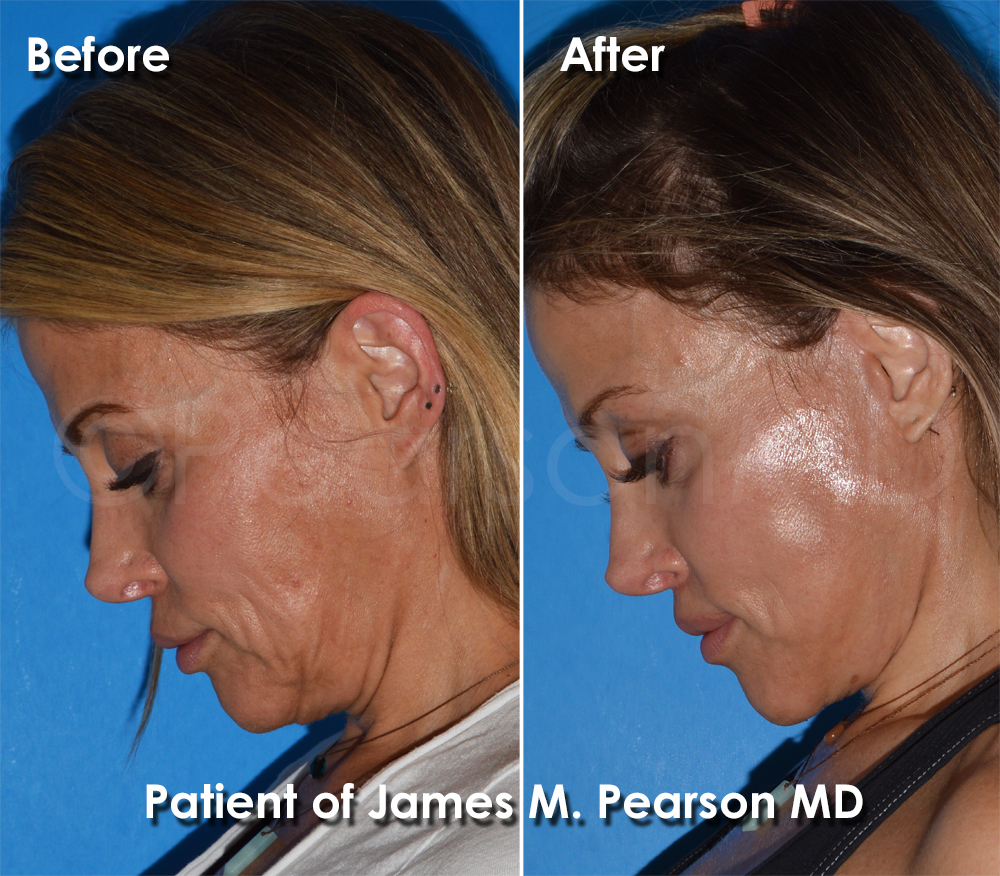 Dr. Pearson Facelift
