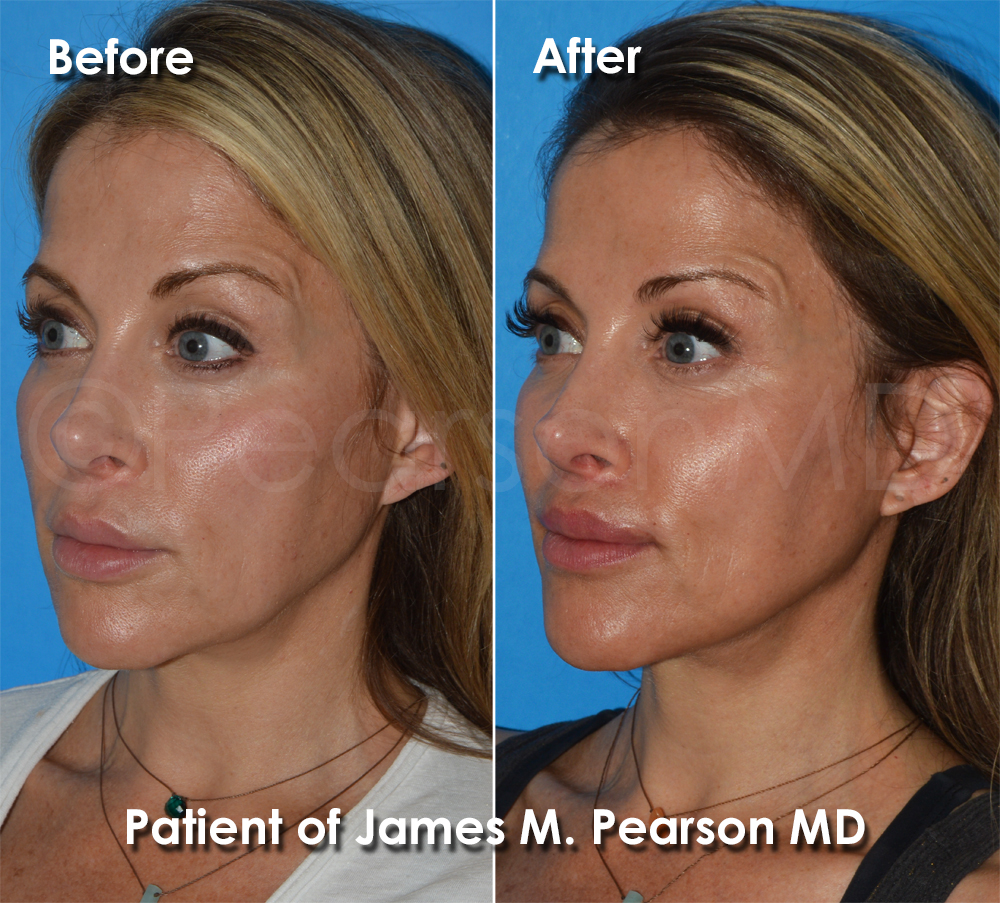 Dr. Pearson Facelift Surgery