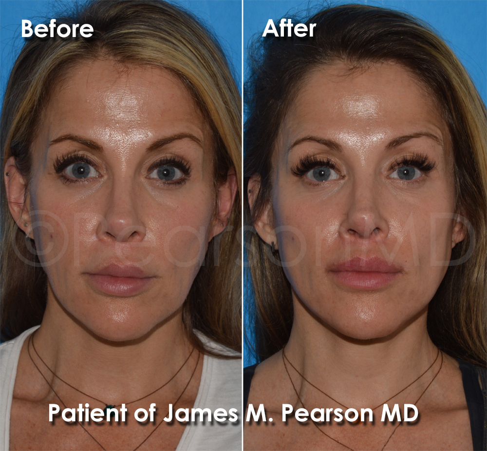 Dr. Pearson Facelift Surgery