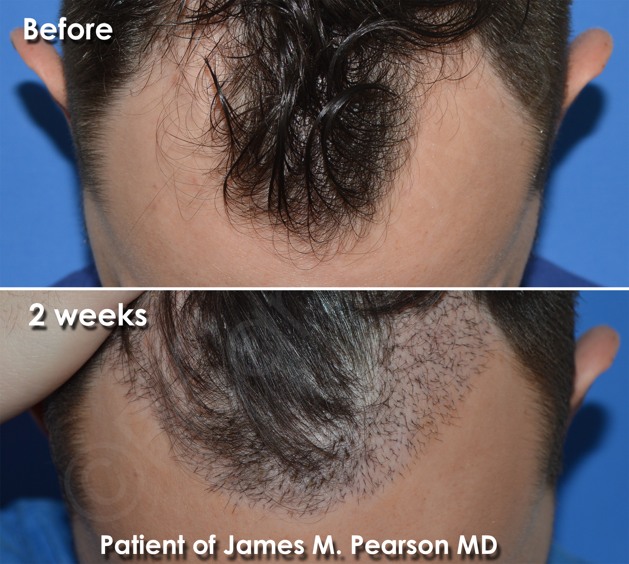 Hair Restoration - Dr. James Pearson Facial Plastic Surgery