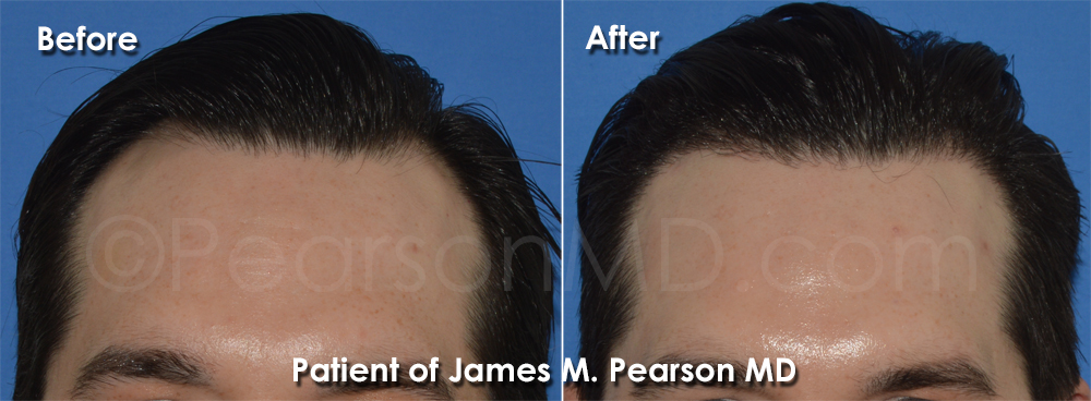 Pearson Hair Restoration