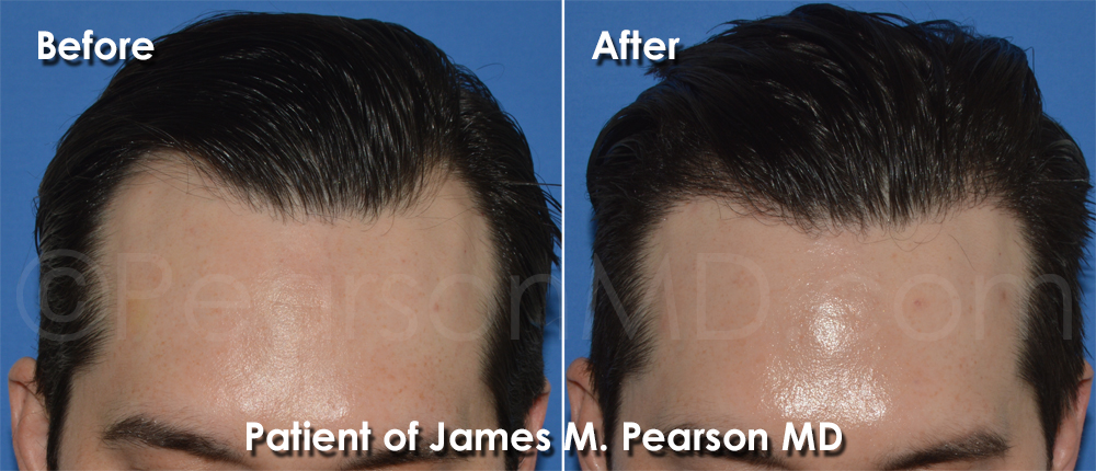 Pearson Hair Transplant