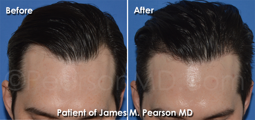 Dr. Pearson Hair Restoration