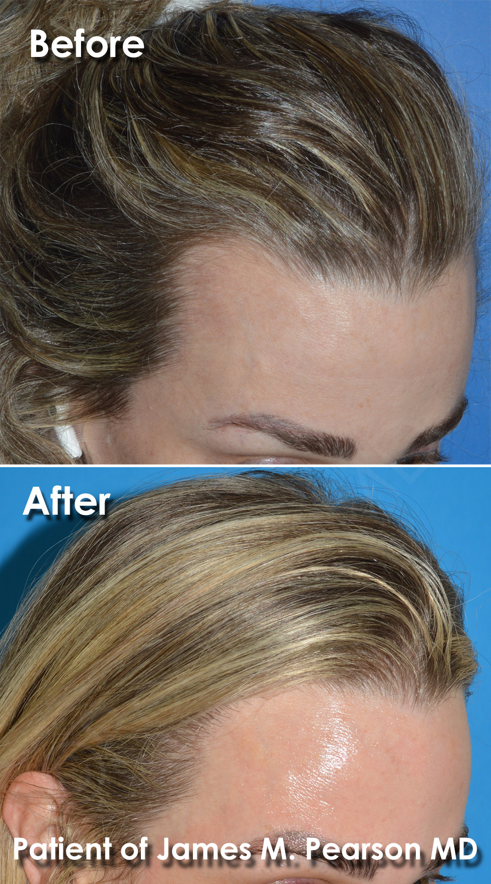 Los Angeles Hair Restoration