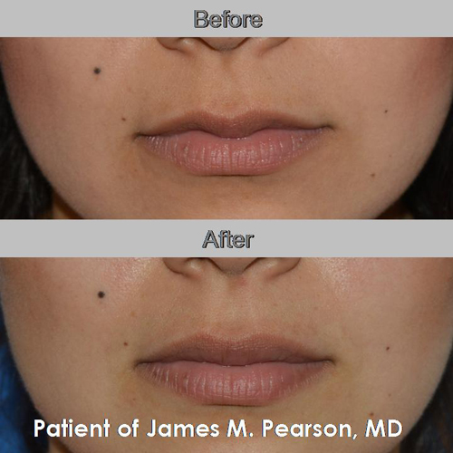 Pearson Lip Enhancement Photos