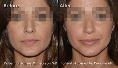 Pearson Lip Implant Photos