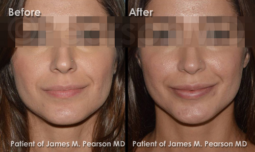 Pearson Lip Implant Photos
