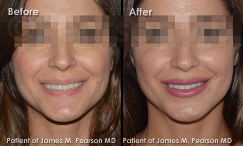 Pearson Lip Implant Photos