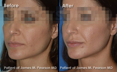 Pearson Lip Implant Photos