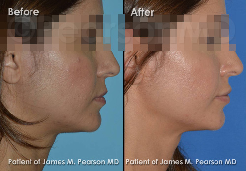 Pearson Lip Implant Photos