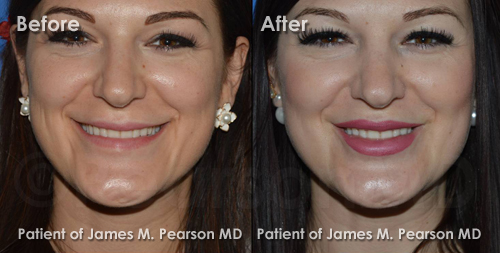 Pearson Lip Enhancement Photos