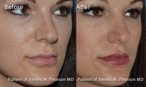 Pearson Lip Implant Photos