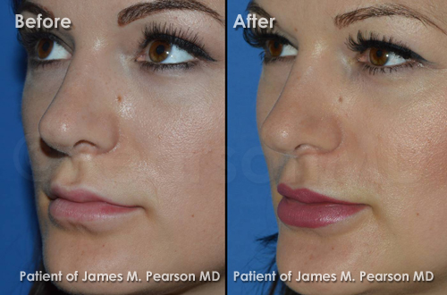 Pearson Lip Surgery Photos