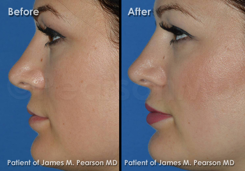 Pearson Lip Enhancement Photos