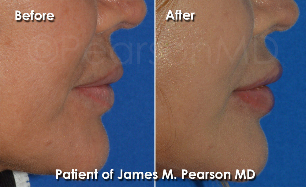Pearson Plastic Surgery