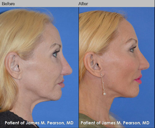 Pearson Midface Lift Photos
