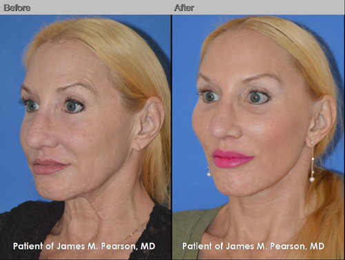 Pearson Cheek Lift Photos